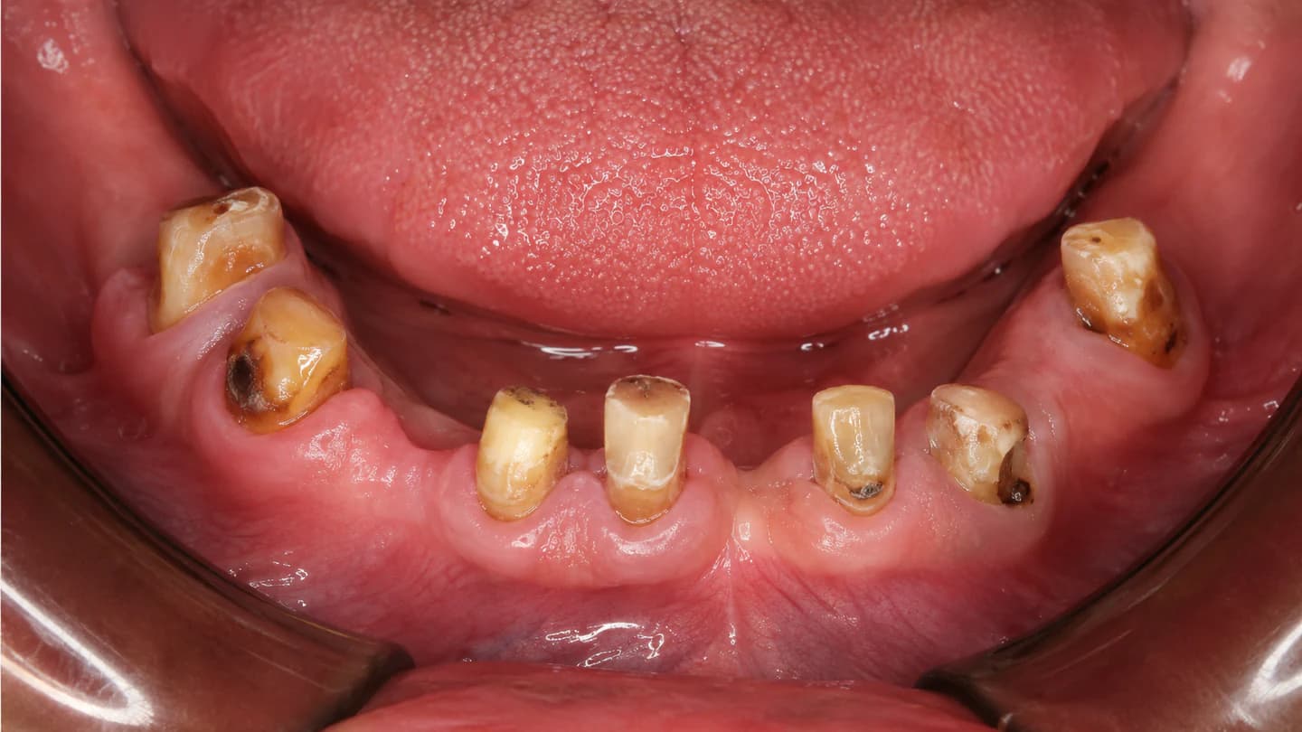 Before Full-Arch Fixed Implant Bridge