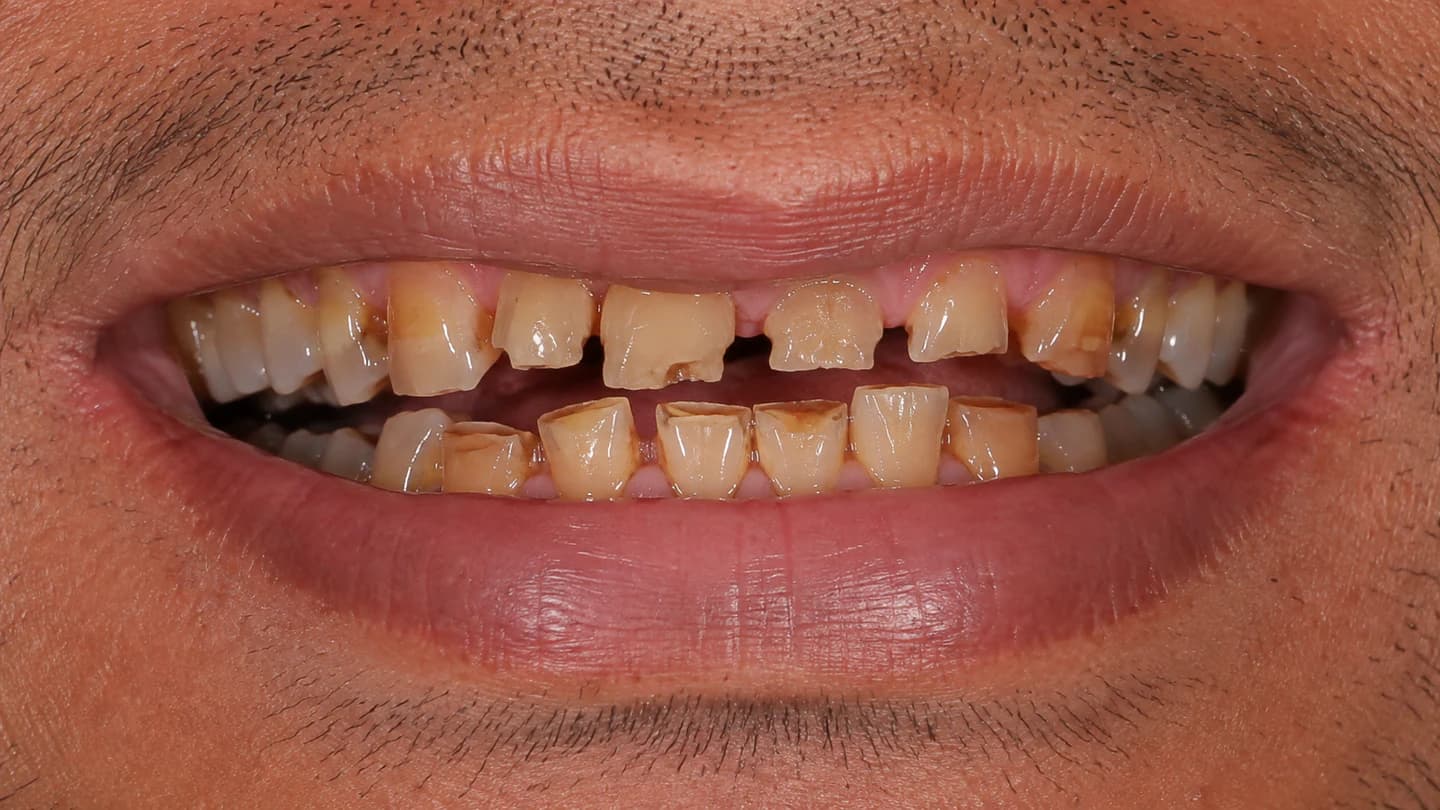Full-Mouth Functional Rehabilitation - Initial Condition Before Treatment